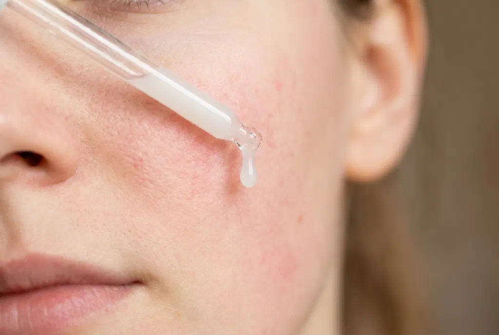 Pipette with azelaic acid serum over fair skin with redness