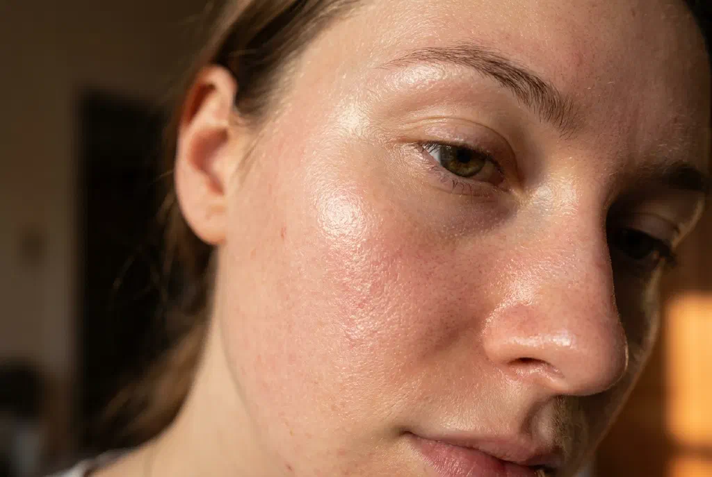 Close-up of a shiny area of the face with visibly enlarged pores